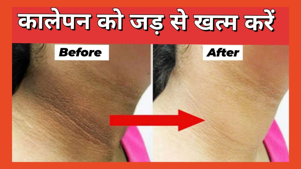 Dark Neck Home Remedies काली गर्दन को साफ करने के लिए लगाएं ये चीज़, रातों-रात Dark Neck से पाएं छुटकारा